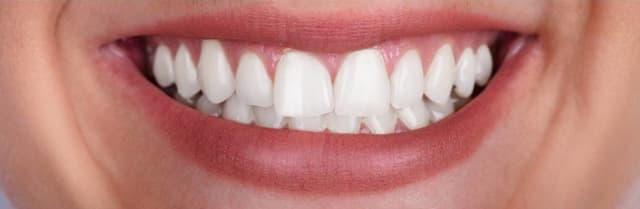 After Teeth Whitening